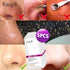 5pcs Powerful Pore Strips + Skin Soother - Removes Deep Rooted White Heads + Blackheads