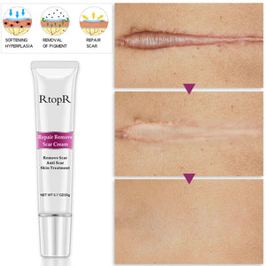 Intense Scar Removal Treatment (Works on Acne Scars Too)